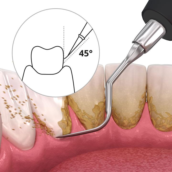 Immagine prodotto Ailoria Depennato (Pulitore sonico per denti)