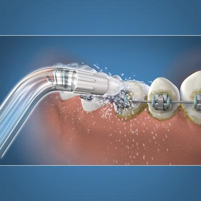 Image du produit Waterpik Orthodontie (Embouts de douches buccales)