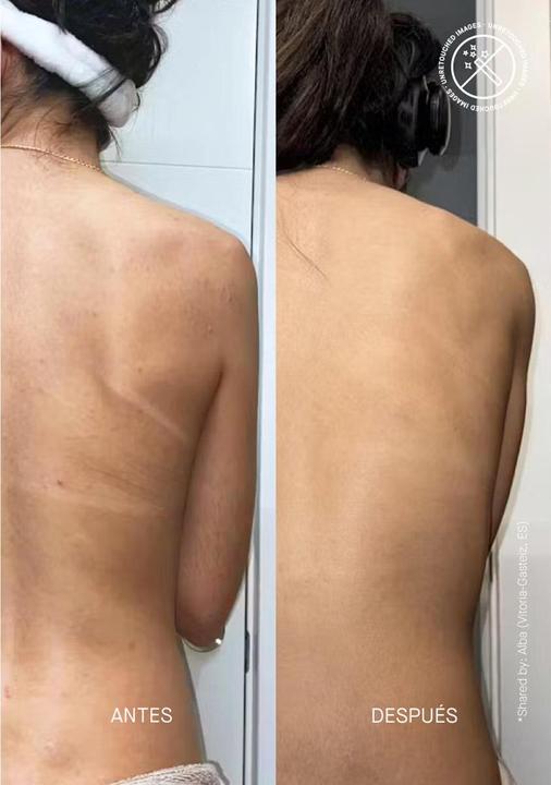 Actual product image Acnemy Zitback (Body lotion, 80 ml)