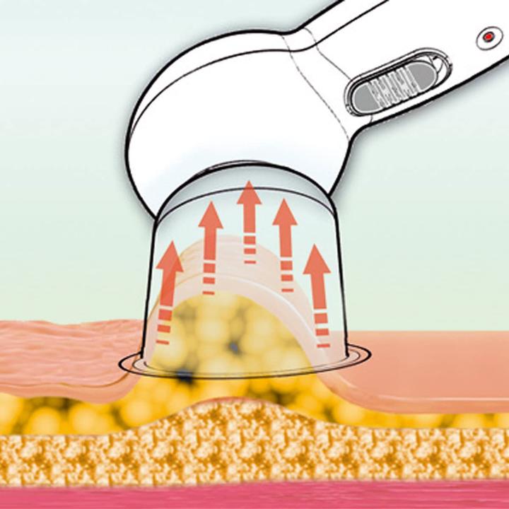 Immagine prodotto Prorelax Massaggiatore di vuoto anticellulite