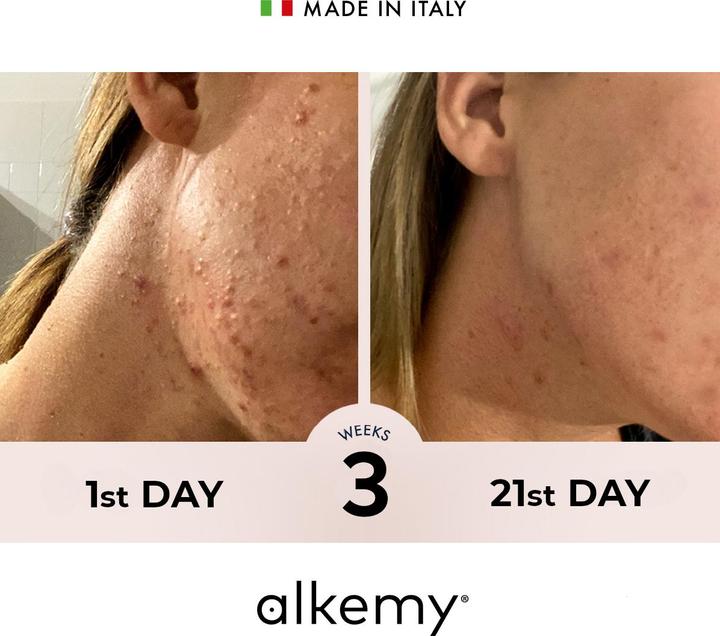 Image du produit Alkemy Crème Boutons Visage - Cosmétique Naturelle – Anti Acne (Crème 24h)
