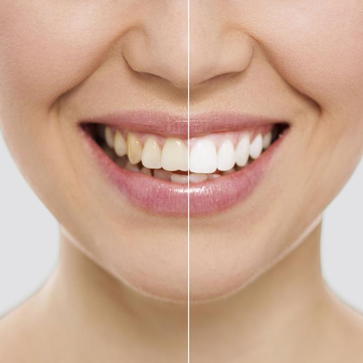 Actual product image InnovaGoods Tooth whitening strips Wripes (Strips)