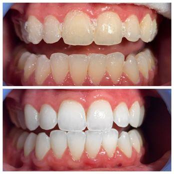 Produktbild SmilePen SonicBlue Whitening (Schallzahnbürste)