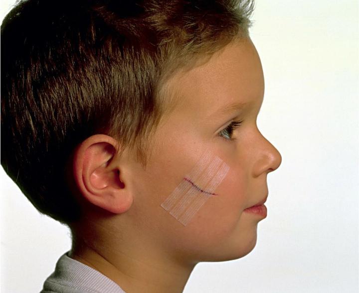 Image du produit Nexcare Steri-Strip Bande de fermeture de plaie (6 x)