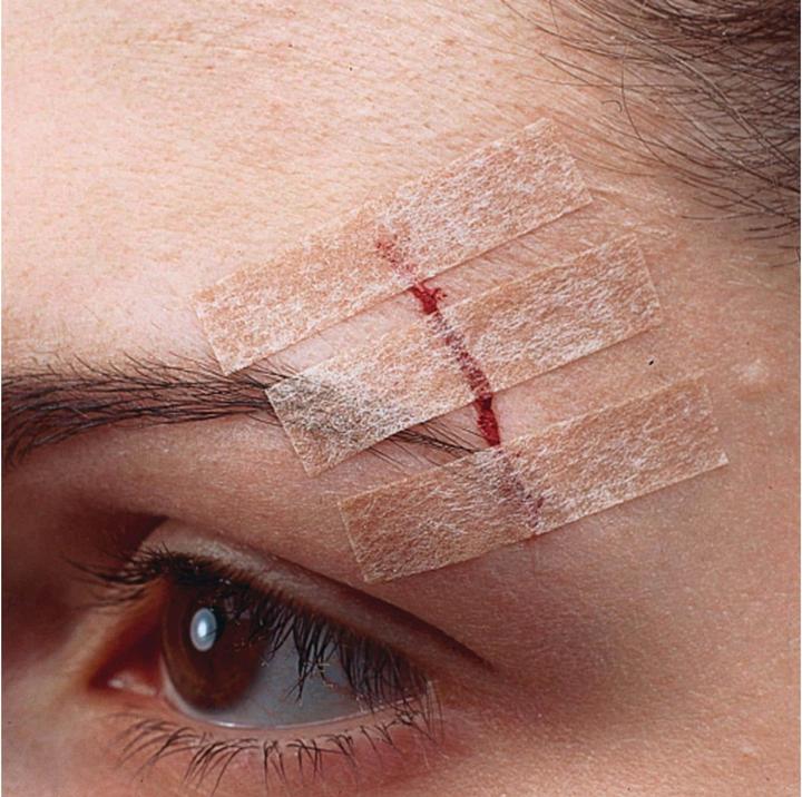 Image du produit Nexcare Steri-Strip Bande de fermeture de plaie (6 x)