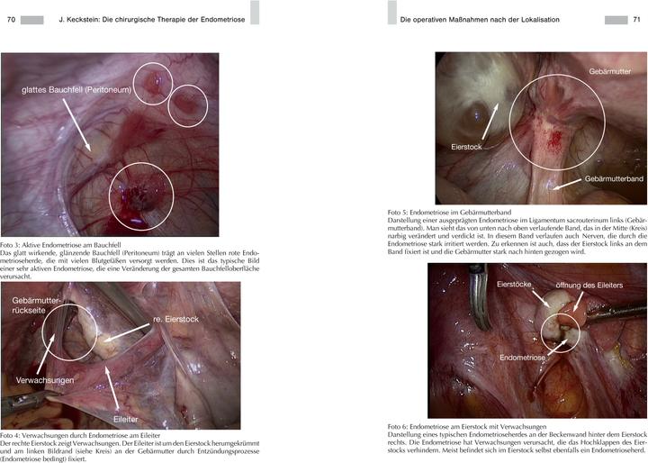 Immagine prodotto Endometriose - Die verkannte Frauenkrankheit (Tedesco, Joanna Lupo, Prof Jörg Keckstein, MD, Dott.ssa Anja Maria Engelsing, Prof Dr med Gerhard Leyendecker, 2019)